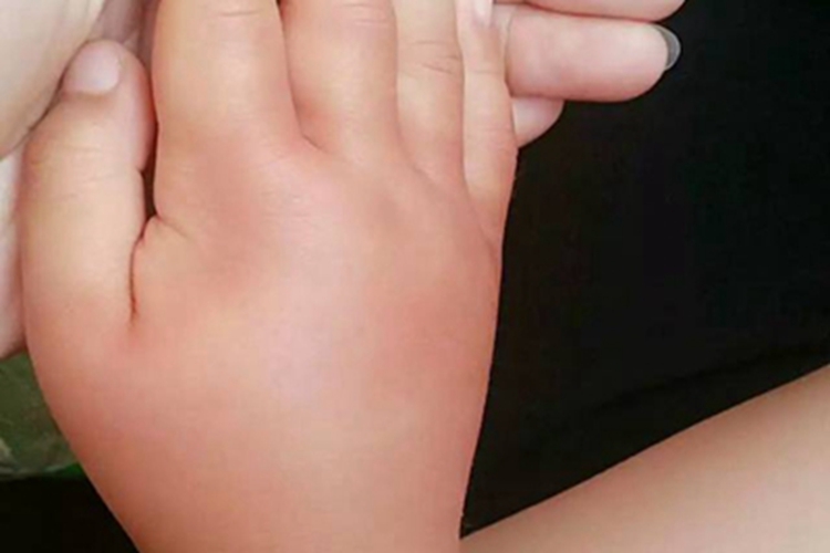 皮肤丝虫病急性期症状图