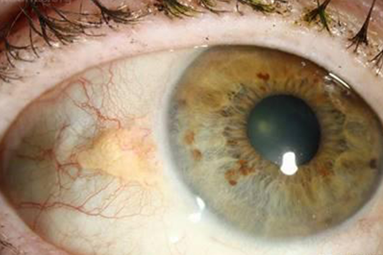 睑裂斑黄白色结节状凸起图