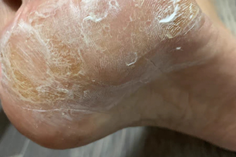 足癣脚底裂纹图