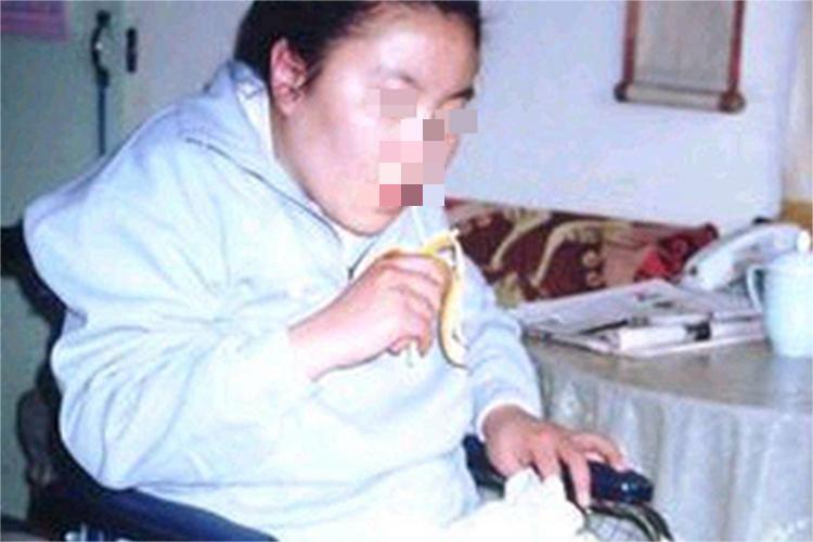 慢性铊中毒颈部肌肉萎缩图