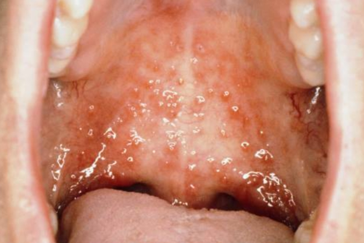 白血病口腔炎图 白血病口腔炎图