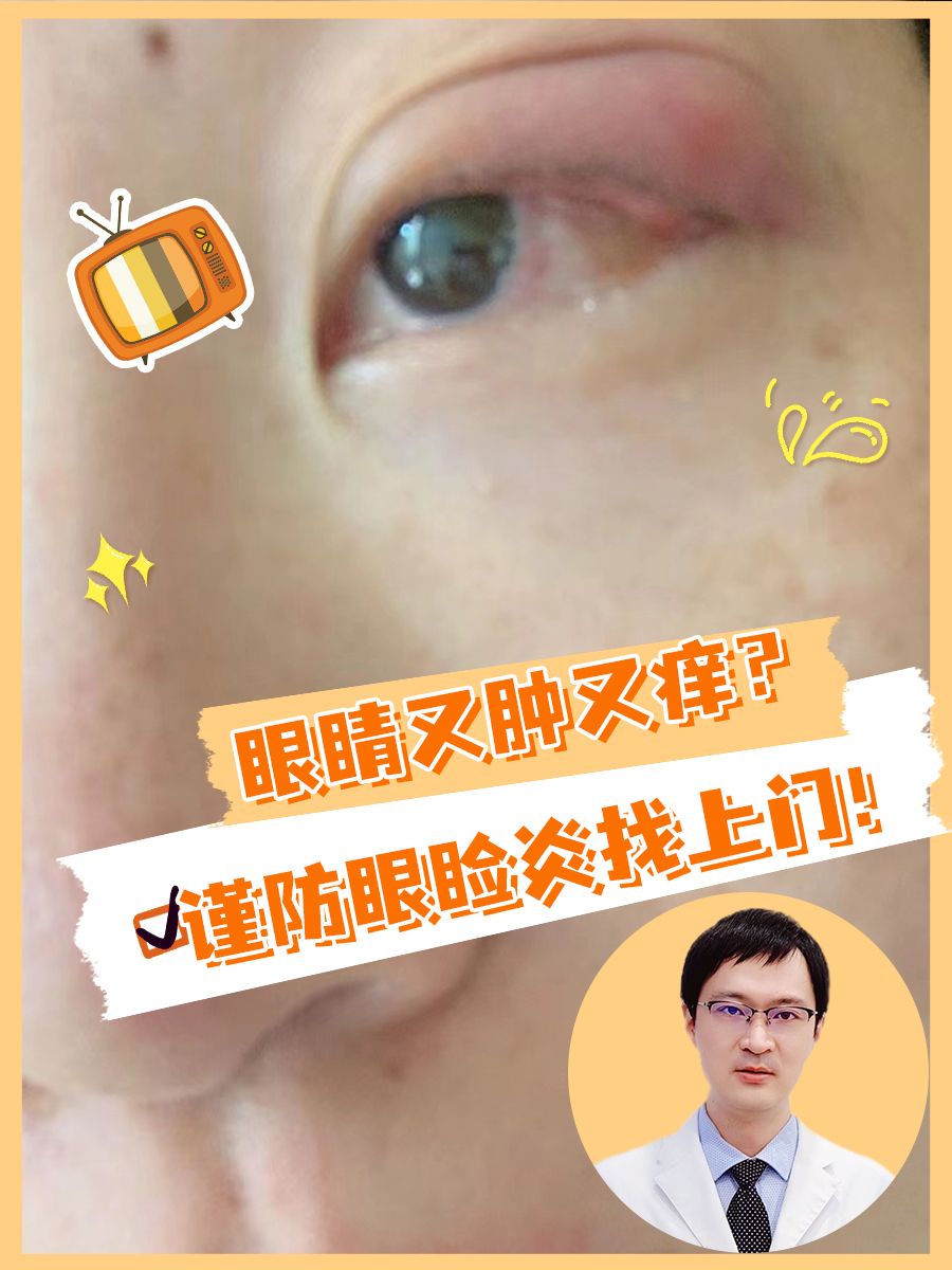 眼睛又肿又痒?谨防眼睑炎找上门!