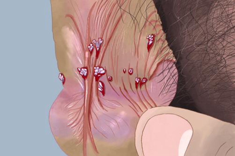 阴茎尖锐湿疣图