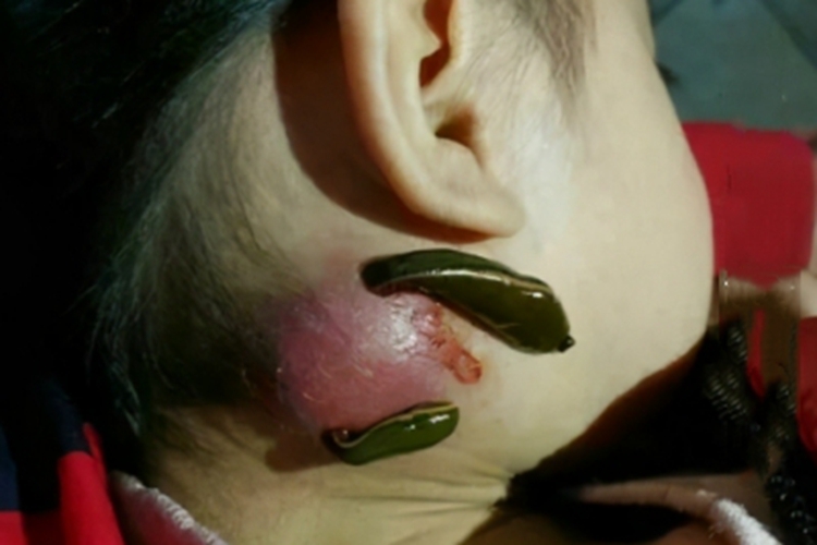 水蛭咬伤大包图 水蛭咬伤大包图