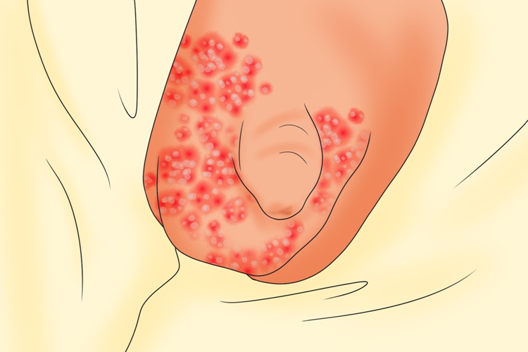 阴囊血管角化瘤图