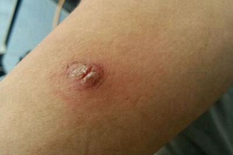 职业性疣赘胳膊疙瘩图