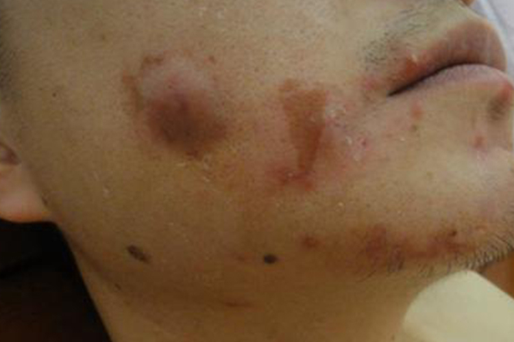 脸上瘢痕疙瘩图