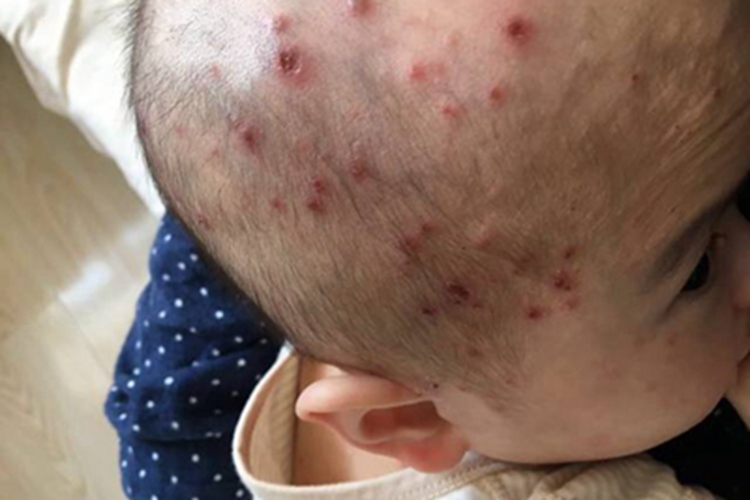 水痘头皮结痂图