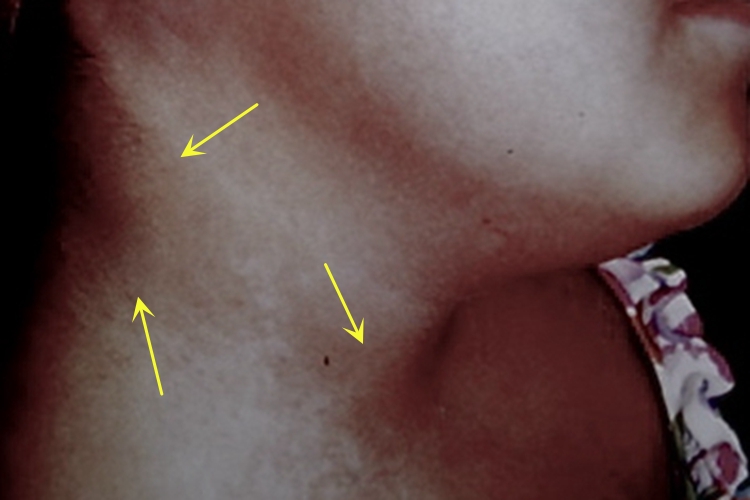 脱色性色素失禁症颈部有斑图