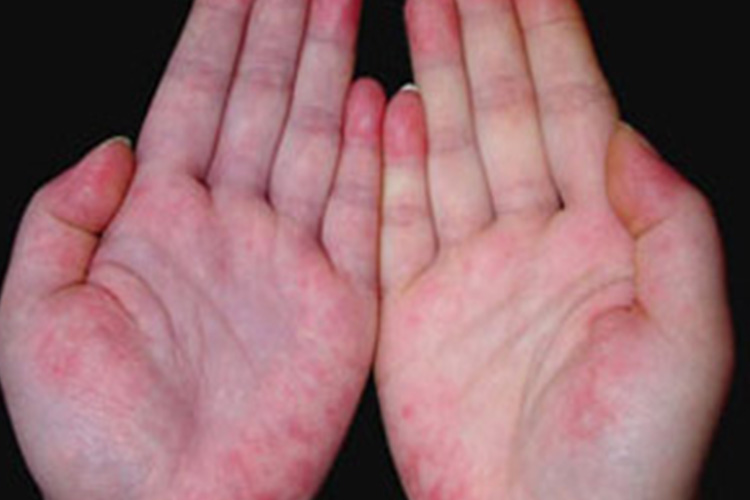 指端紫红色斑疹图 指端紫红色斑疹图