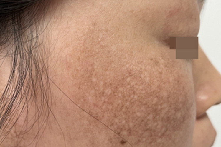 黑变病面部症状图