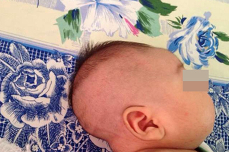 狭颅症宝宝头很尖图 狭颅症宝宝头很尖图