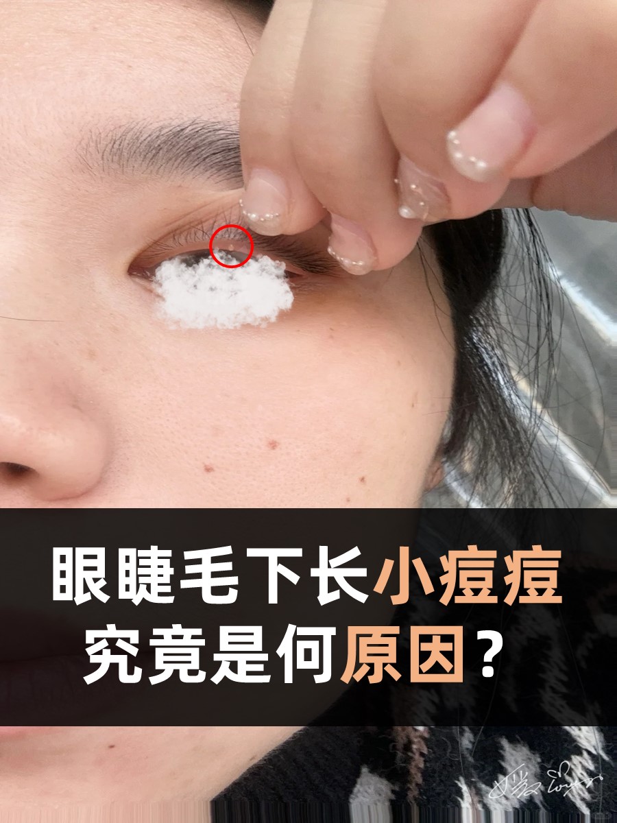 眼睫毛下长小痘痘，究竟是何原因？