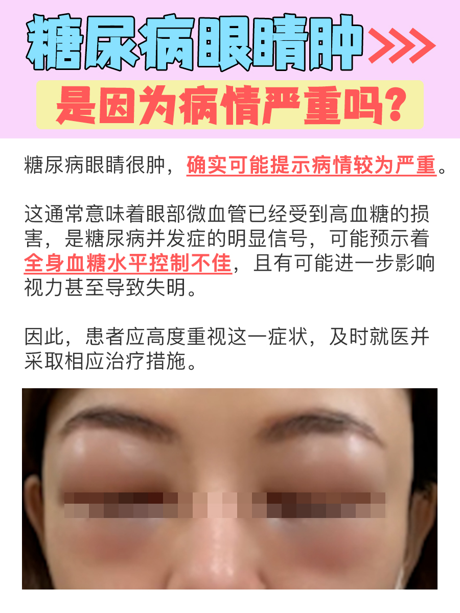糖尿病眼睛很肿,提示病情严重吗?