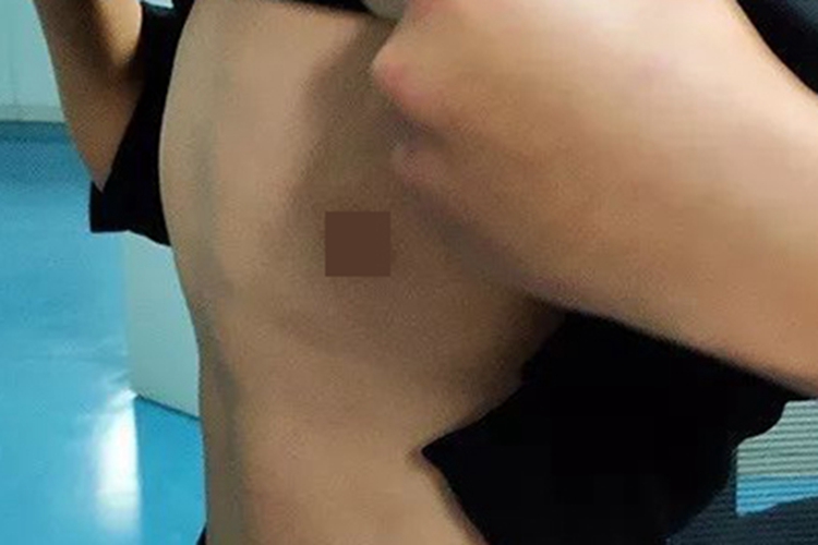 肋膈沟愈合后图