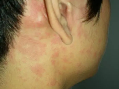 轻型麻疹耳朵周围有红色疹子图.jpg