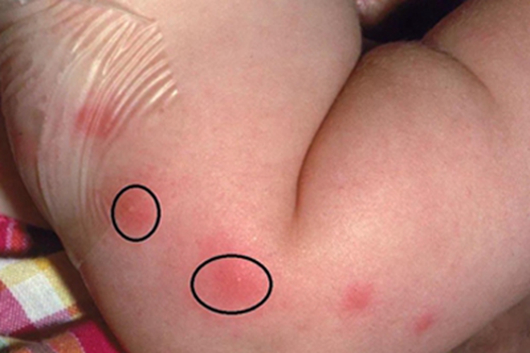 痒疹腿部红斑图