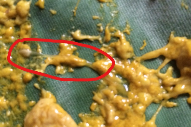 蛲虫病粪便图 蛲虫病粪便图