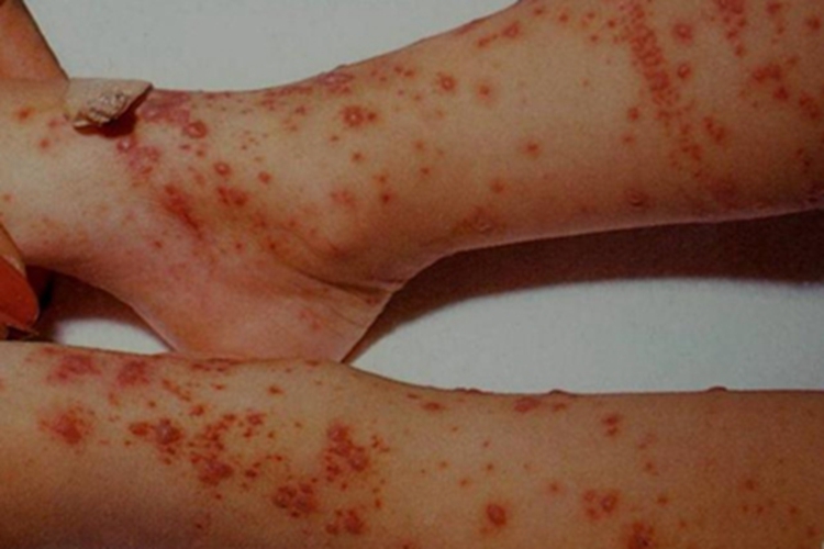 水痘小腿小红疙瘩图