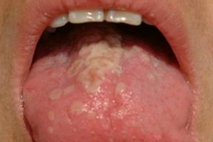 过敏性接触性口炎舌头症状图