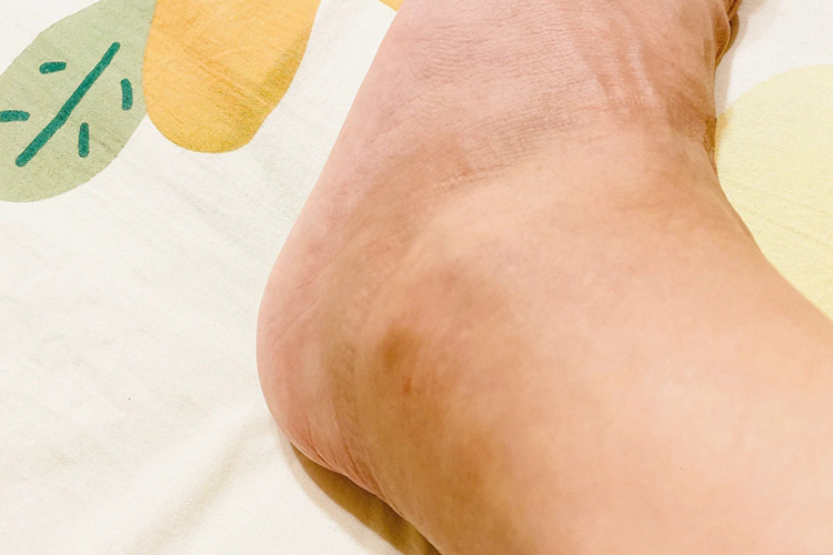 脚踝扭伤慢性期图