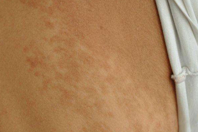 进行性色素性皮肤病背部症状图