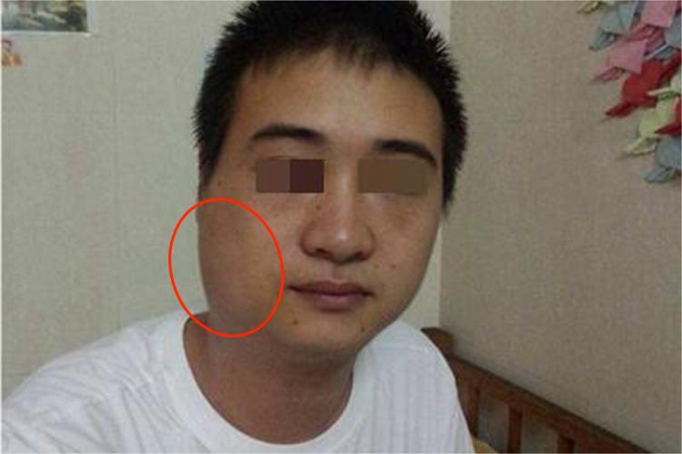 急性化脓性腮腺炎面部肿胀图