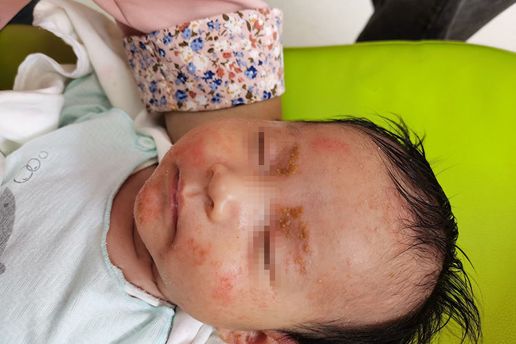 婴儿面部湿疹图 婴儿面部湿疹图