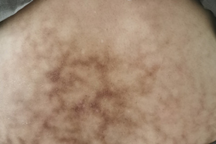 火激红斑腰部褐斑图
