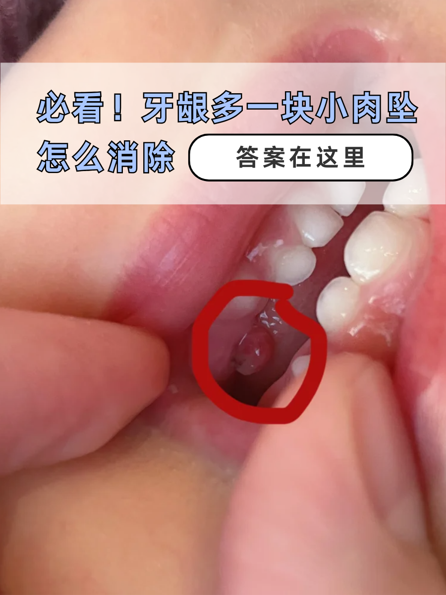 必看！牙龈多一块小肉坠怎么消除，答案在这里