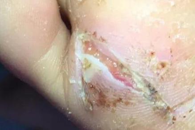 右脚足底外伤图