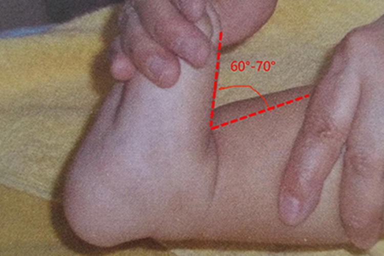 足背屈角的正常值图