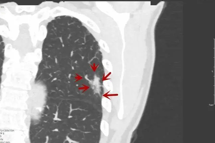 恶性肺结节毛刺征图