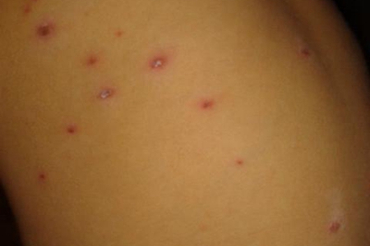 水痘肋部有一些红疙瘩图