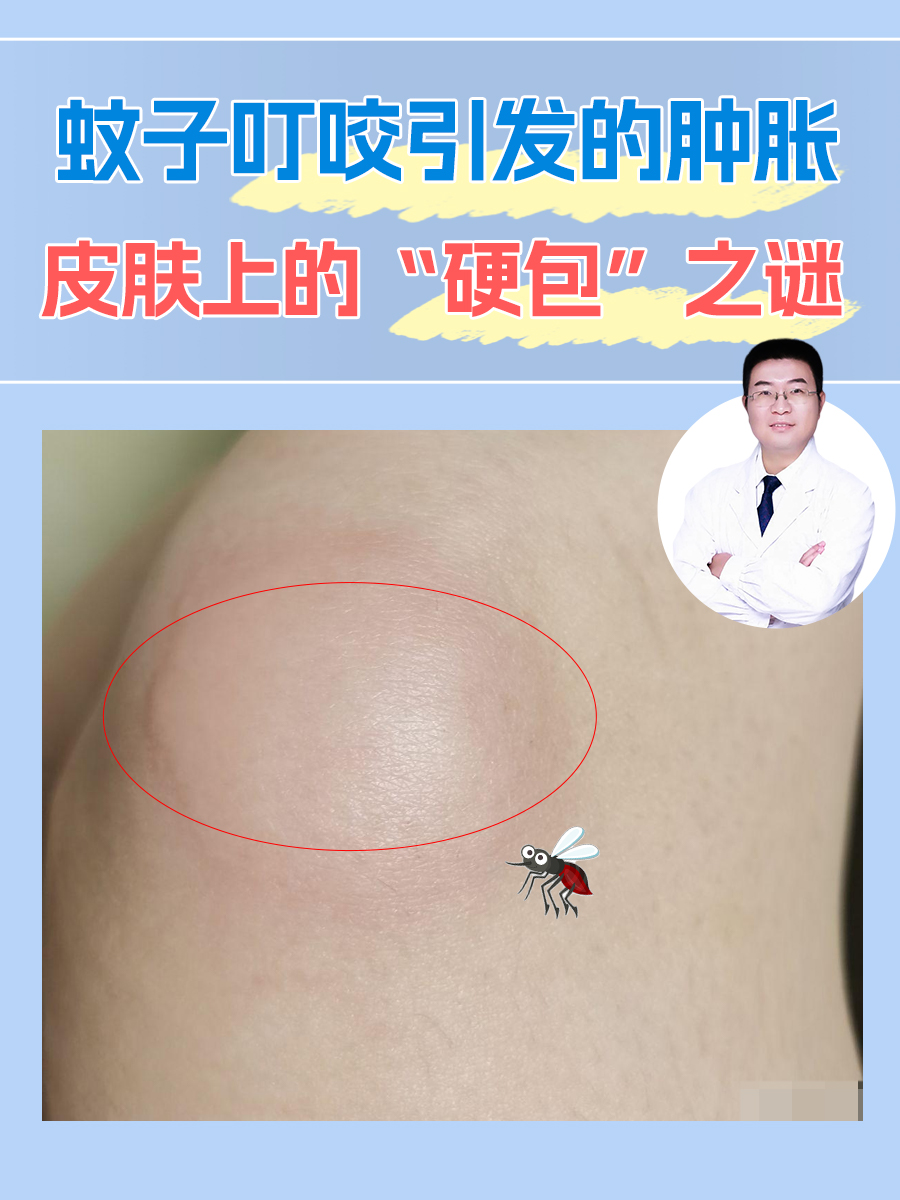 蚊子叮咬引发的肿胀：皮肤上的“硬包”之谜