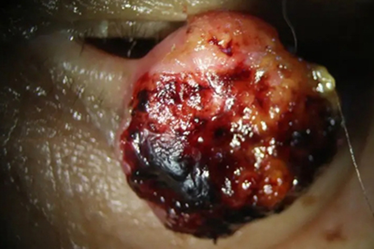 眼睑皮脂腺癌大疙瘩图