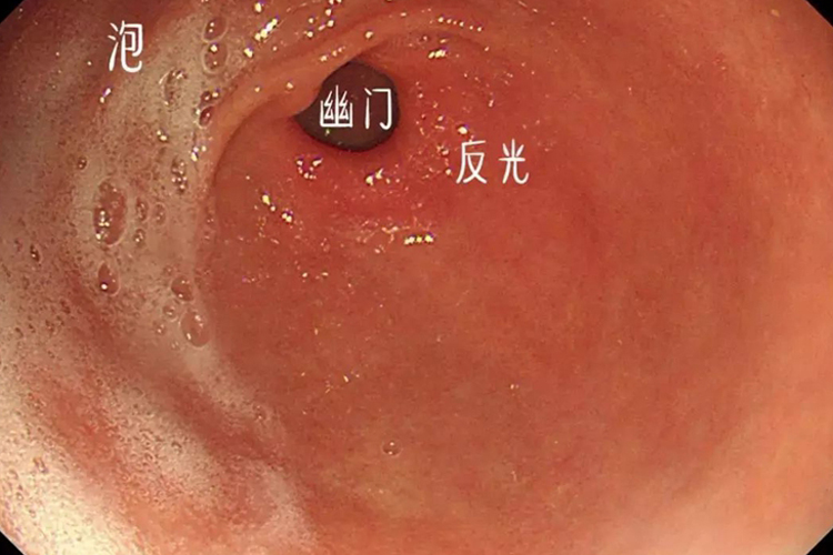 正常胃黏膜镜下图