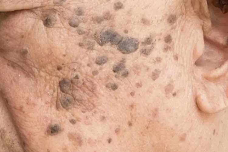 老年性皮肤萎缩面部黑斑图