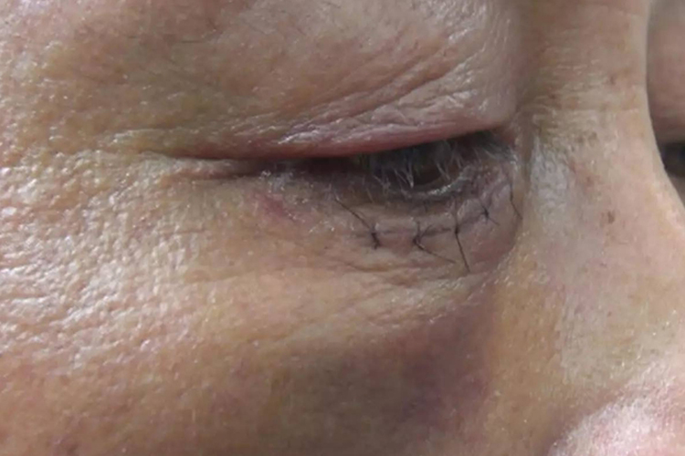 眼眶内侧壁骨折术后图