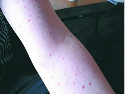 皮肤白血病胳膊上长红点图