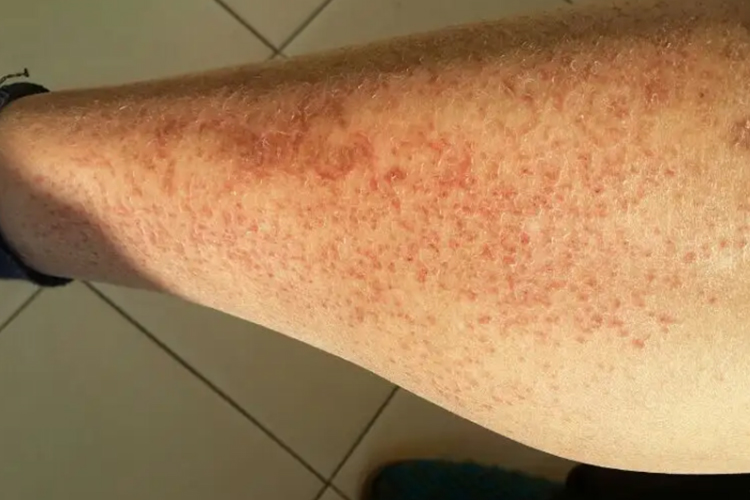 腿部丘疹图 腿部丘疹图