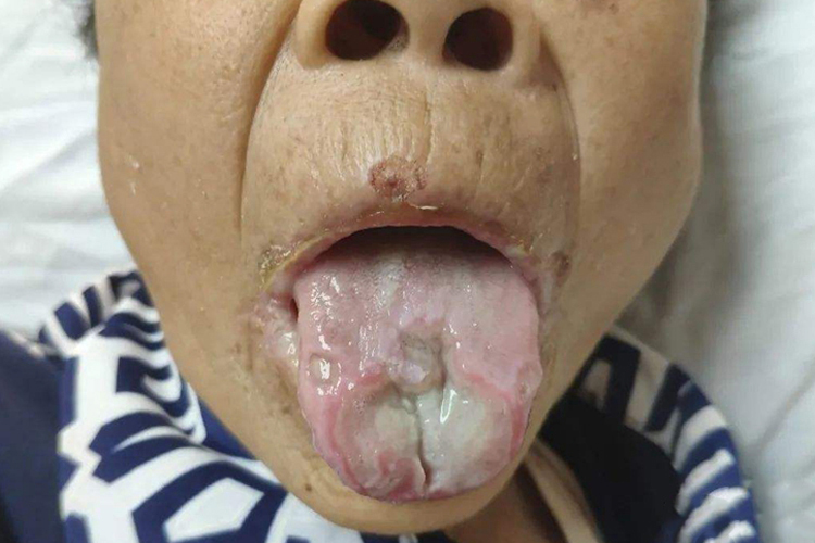 腐蚀性食管炎舌面凹凸不平图