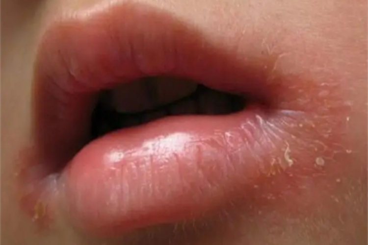 缺铁性贫血嘴唇脱屑图