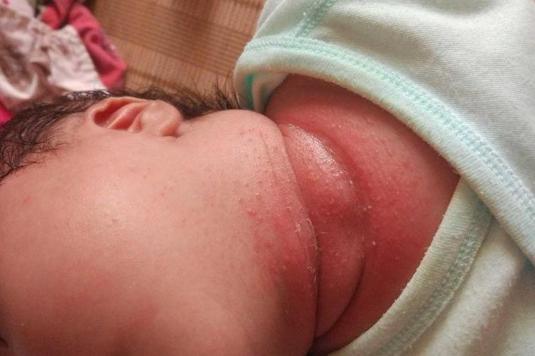 脖子上长湿疹图 脖子上长湿疹图