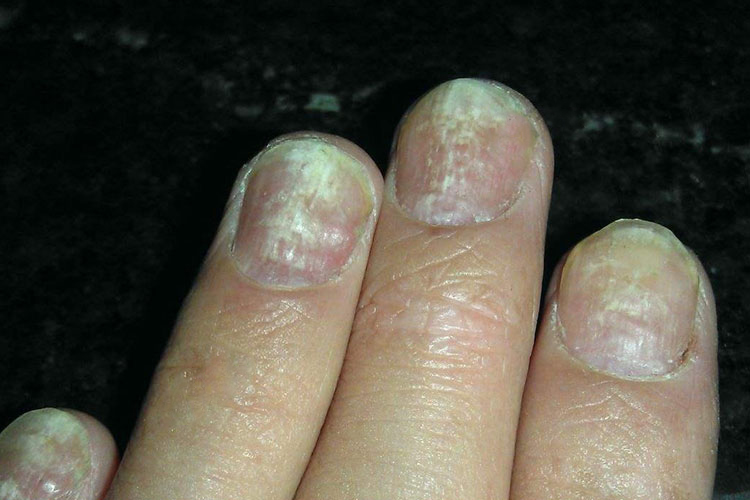白色浅表型灰指甲图 白色浅表型灰指甲图