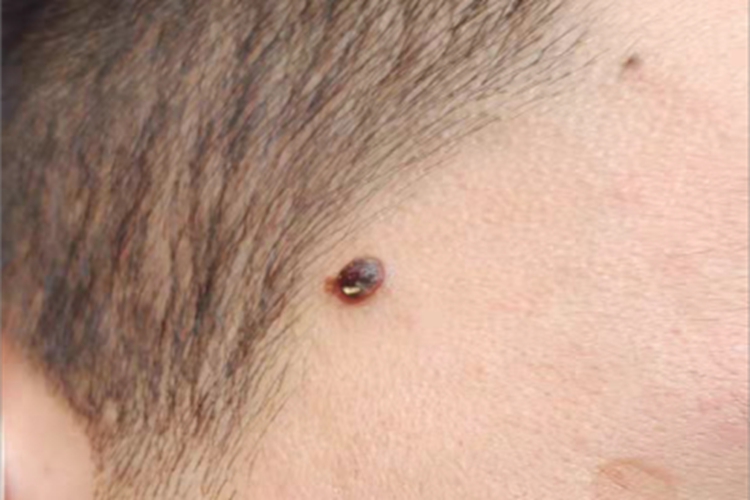 交界痣面部肉球图