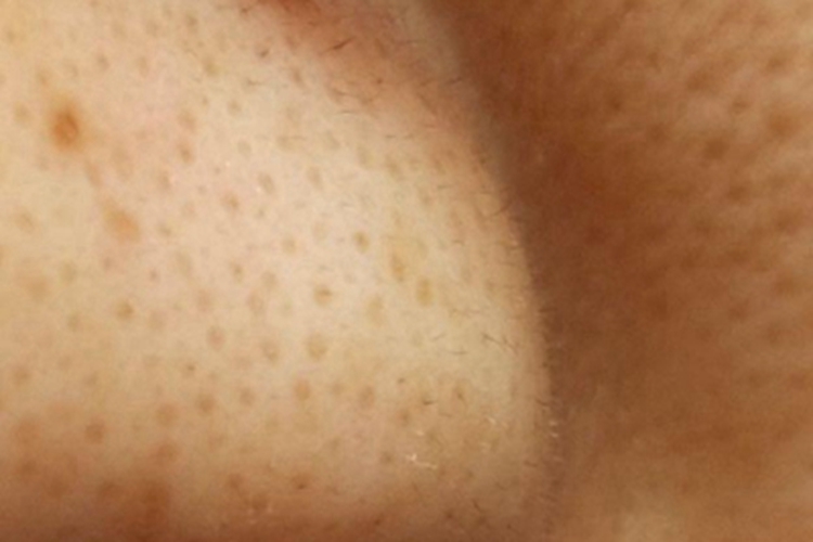 网状色素失禁症鼻翼斑图