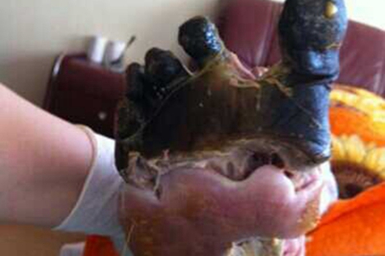 湿性坏疽脚趾坏死发黑图 湿性坏疽脚趾坏死发黑图