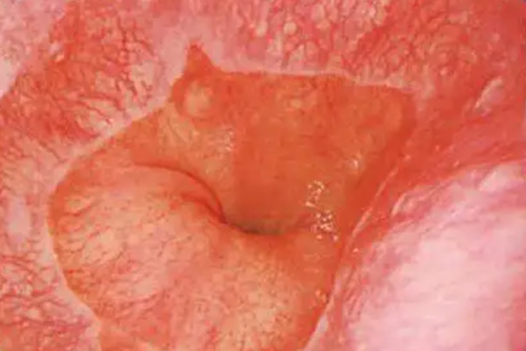 BARRETT食管胃镜图