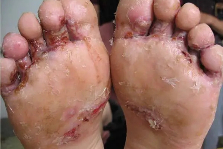 浸渍糜烂型足癣糜烂图 浸渍糜烂型足癣糜烂图